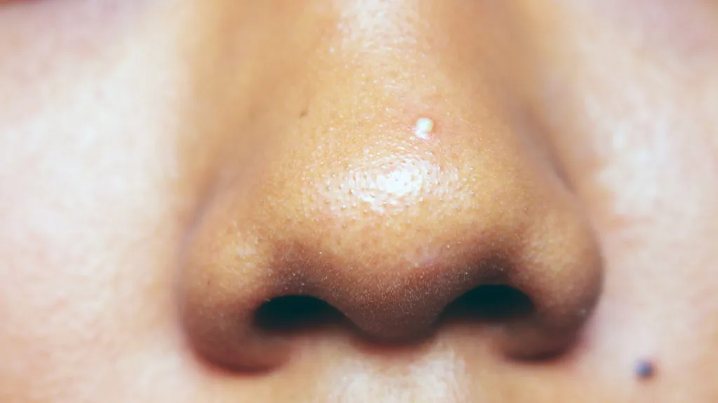 Blackheads on your nose